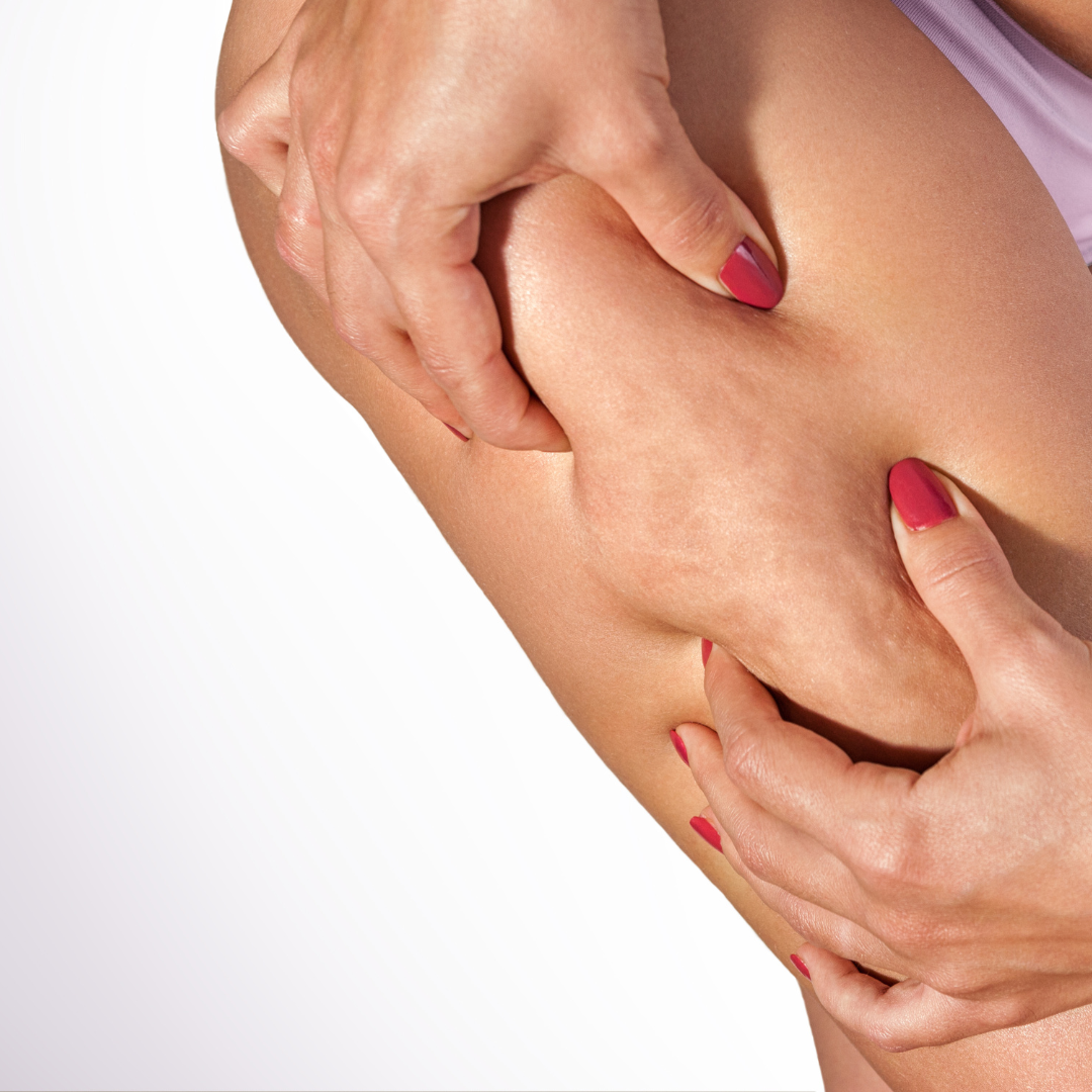 Vacuum Cellulite Therapy