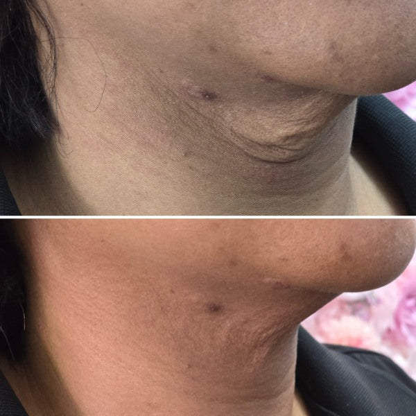 SKIN TIGHTENING