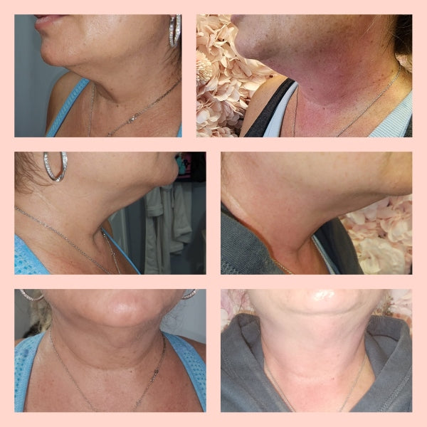 SKIN TIGHTENING