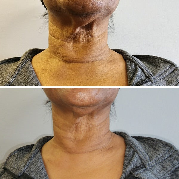 SKIN TIGHTENING