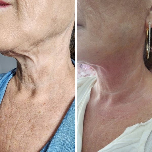 SKIN TIGHTENING