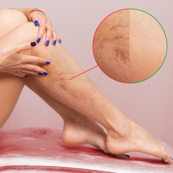 Spider Vein Removal